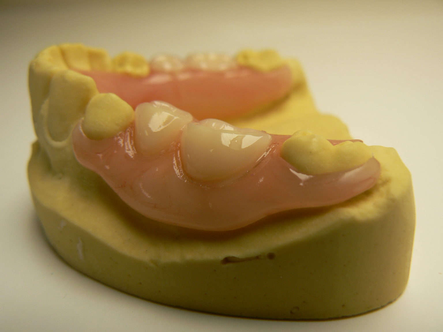 Thermoplastie pressing dental PN Prothèse