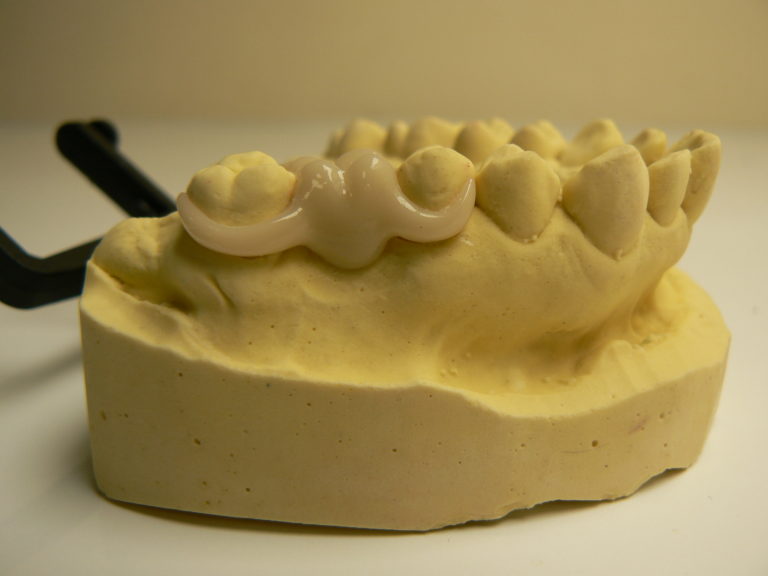 Thermoplastie pressing dental PN Prothèse