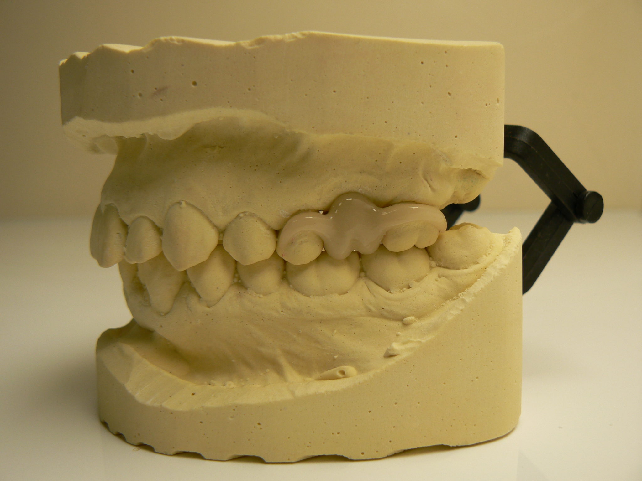 Thermoplastie pressing dental PN Prothèse