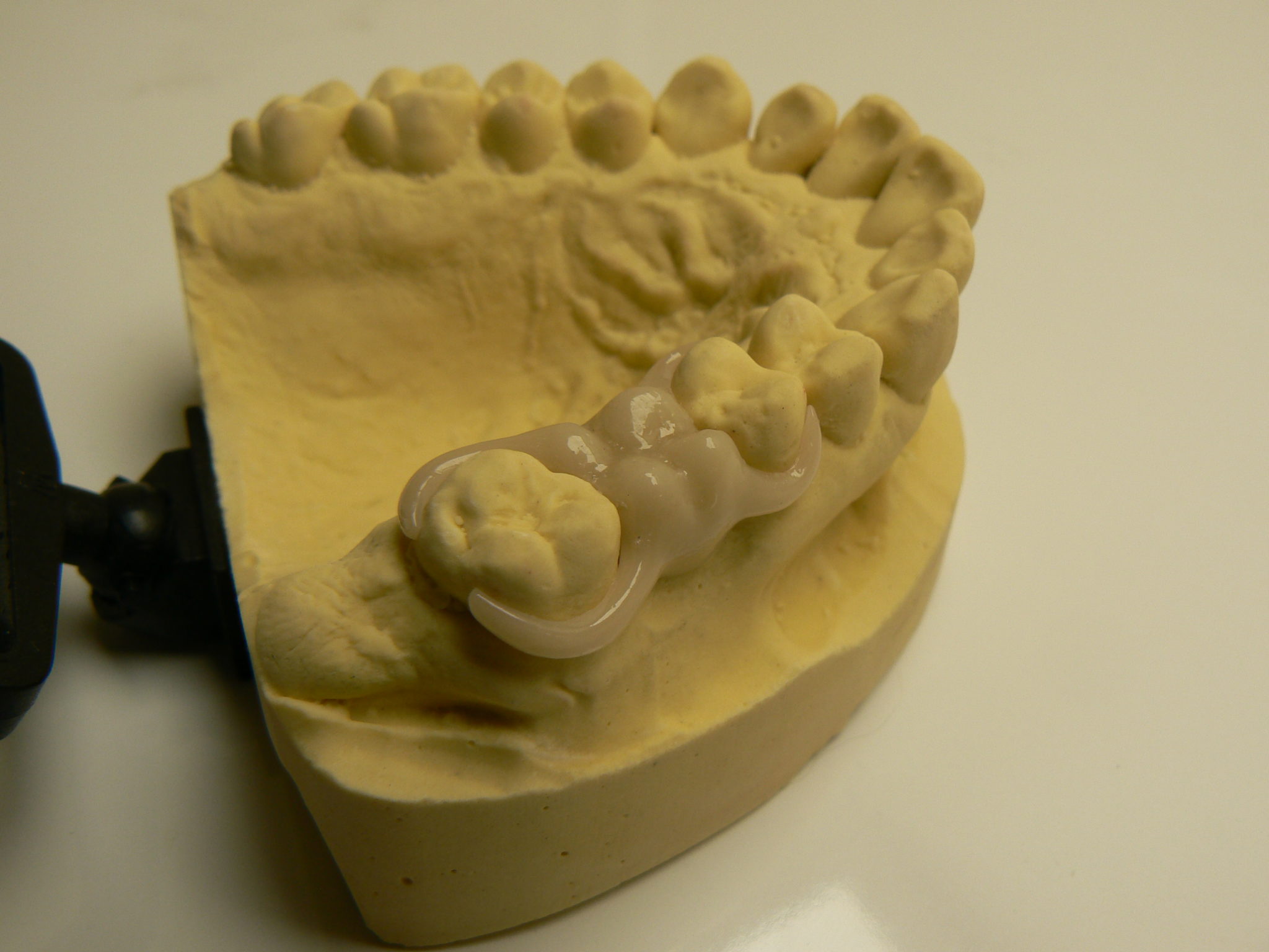 Thermoplastie pressing dental PN Prothèse