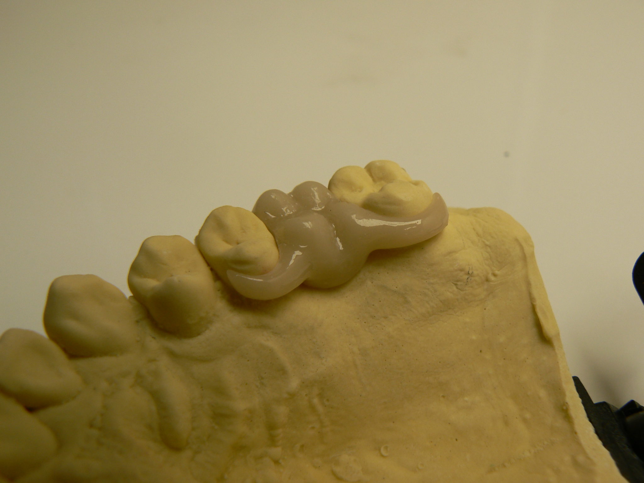 Thermoplastie pressing dental PN Prothèse