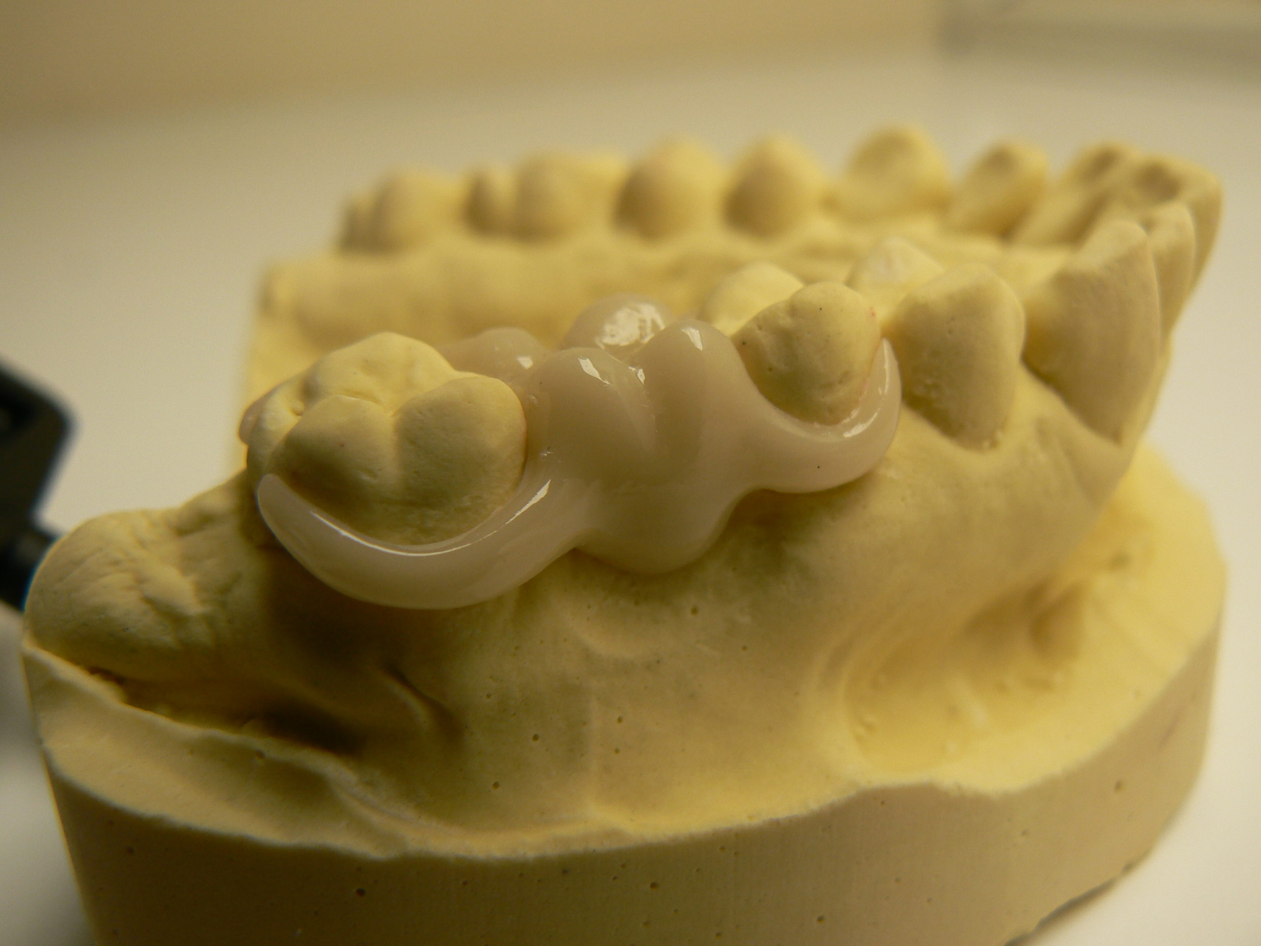 Thermoplastie pressing dental PN Prothèse